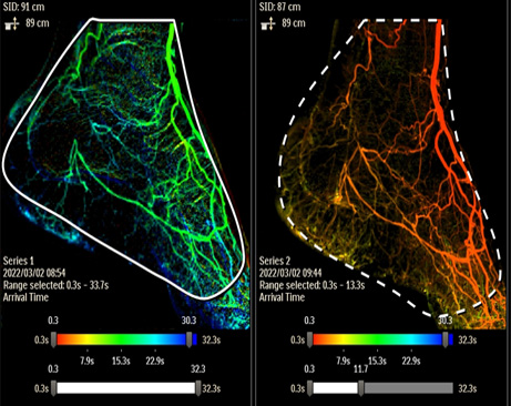 2D Smart Map Perfusion